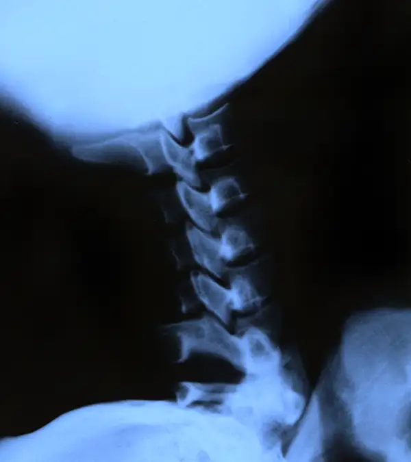 Atlas-axis (C1-C2) diagnostic imaging for upper cervical alignment