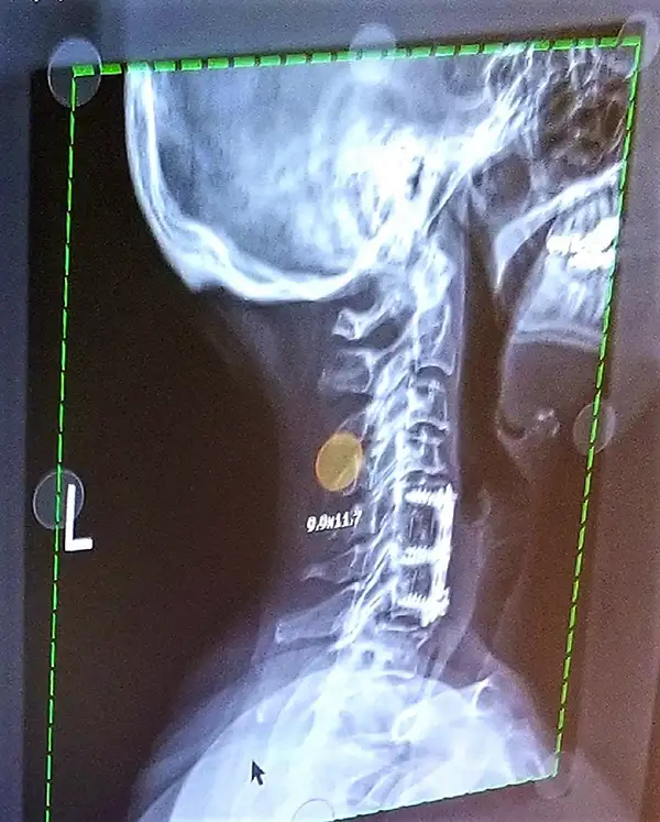 Upper cervical subluxation detection using advanced spinal imaging Arizona